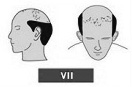 Ilustración de la alopecia de clase 7, dos tercios despejados de la cabeza.