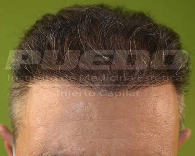 Foto del después de ese mismo caso6 pero ahora ya con pelo