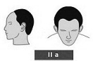 Ilustración de la alopecia de clase 2A Un poquito de entradas mas parte frontal