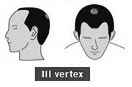 Ilustración de la alopecia de clase 3 vertex Un poquito de entradas y un poquito de coronilla.