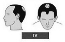 Ilustración de la alopecia de clase 4 entradas pronunciadas, más coronilla.