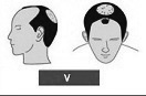Ilustración de la alopecia de clase 5 media frente mas coronilla