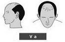 Ilustración de la alopecia de clase 5A frente completa