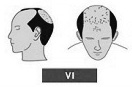 Ilustración de la alopecia de clase 6 frente completa unido a coronilla.