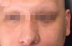 Hombre sin cejas antes de hacerse el injerto capilar de cejas