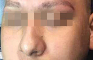 microinjerto de cejas en un hombre que no tenia cejas