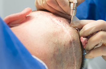 Implanters instrumentos para cirugías capilares